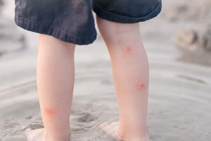 red insect bites on toddler boy's legs